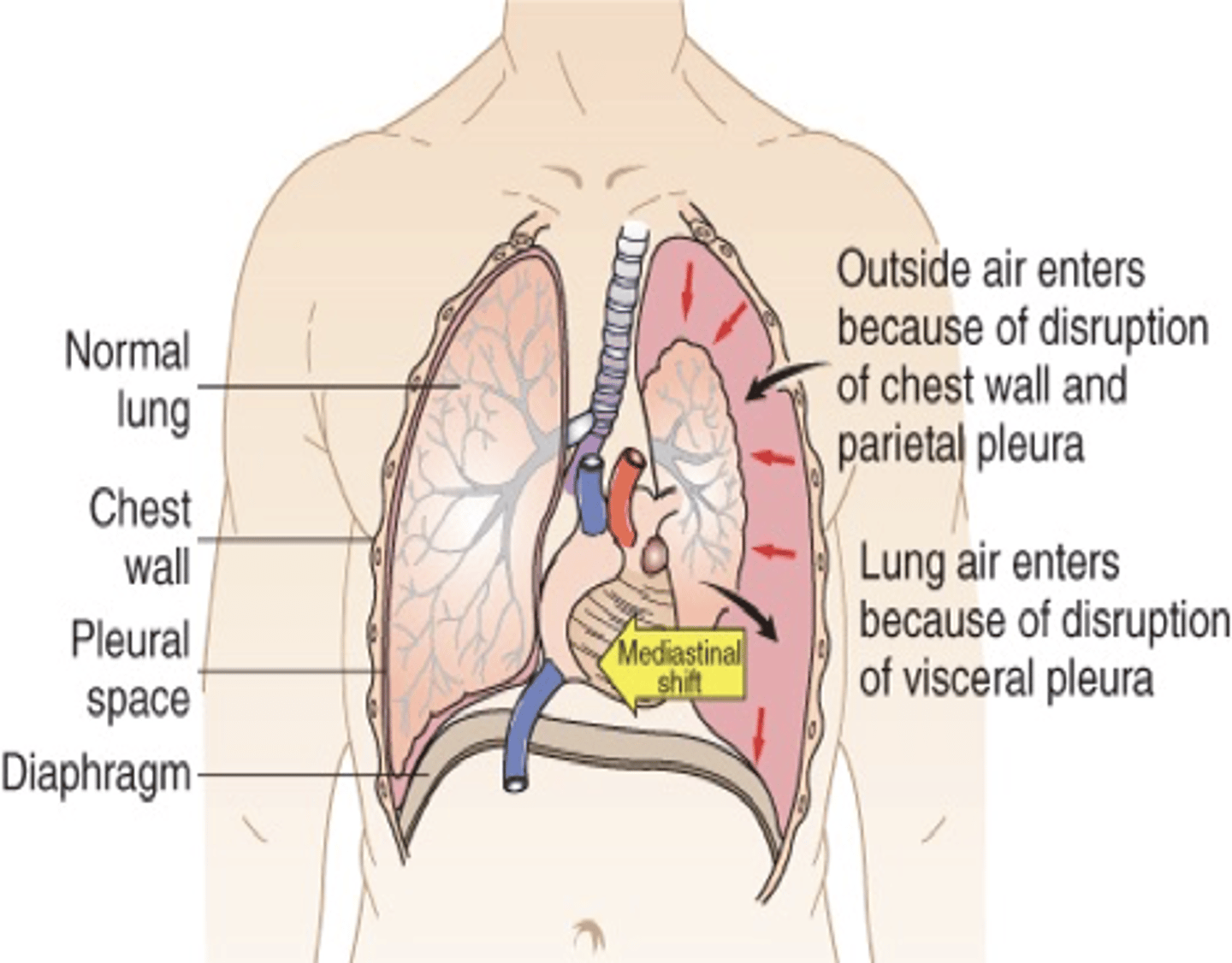 <p>- Site of pleural rupture acts as a one-way valve, permitting air to enter on inspiration but preventing its escape by closing up during expiration</p><p>- As more air enters, air pressure exceeds barometric pressure </p><p>- Air pressure pushes against the recoiled lung causing compression atelectasis, pushes against the mediastinum compressing and displacing the heart</p><p>LIFE THREATENING</p>