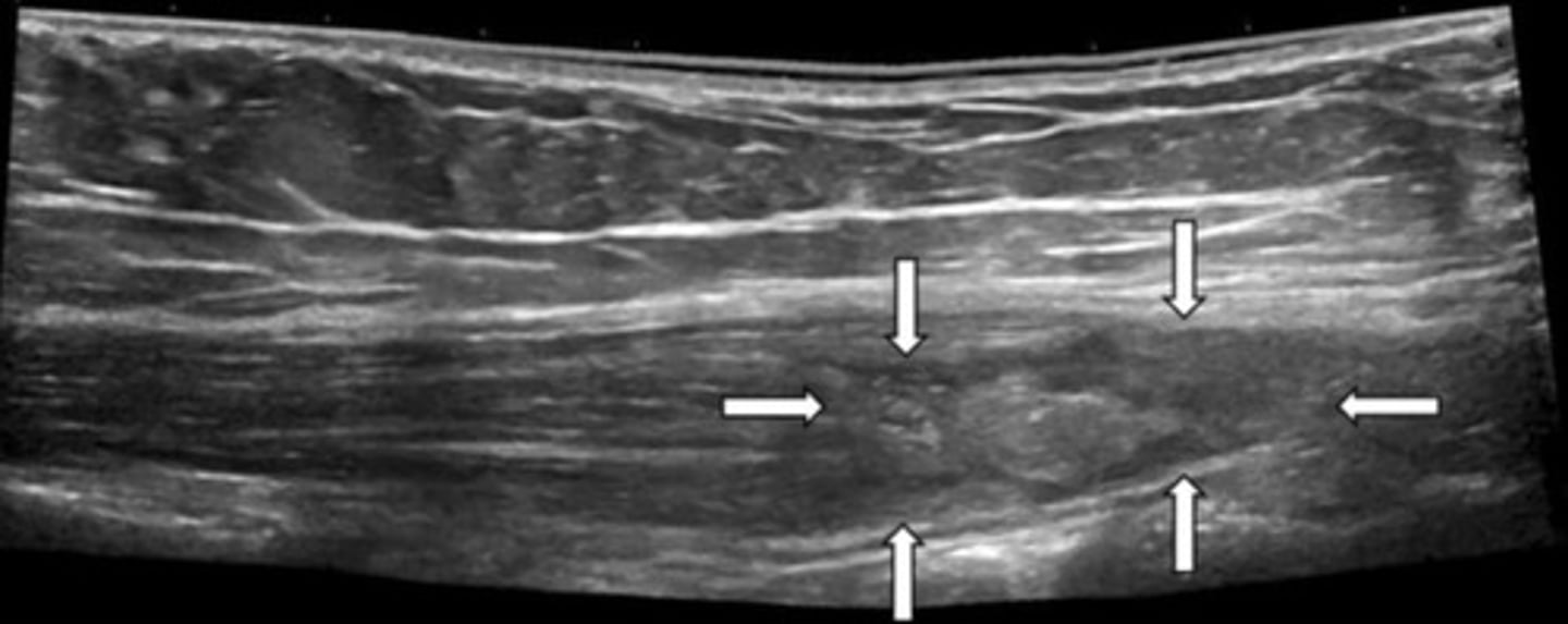 <p>Area of tear = loss of muscle striations, complex appearance with hematoma and muscle swelling/thickness</p>