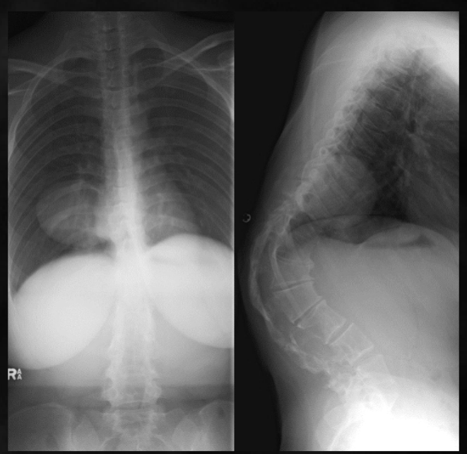 <p>what is seen here for this case of neurofibromatosis type 1?</p>