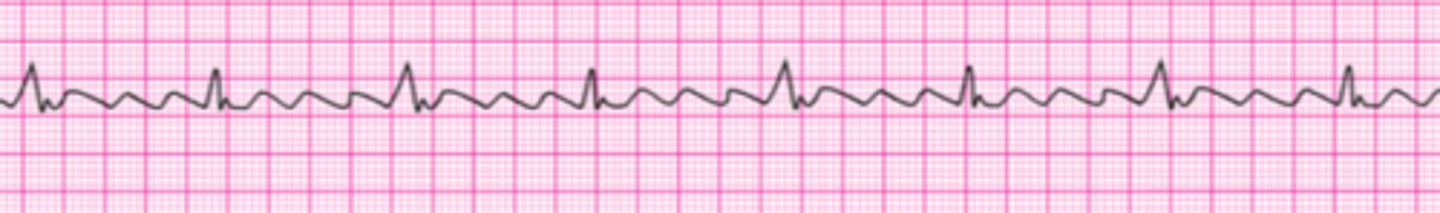 <p>Following resuscitation with CPR and a single shock, you observe this rhythm while preparing the patient for transport. Your patient is stable and blood pressure is 120/80 mm Hg. She is apprehensive but has no symptoms other than palpitations. At this time you would:</p><p>1. Give magnesium sulfate 1 to 2 g over 20 minutes.</p><p>2. Seek expert consultation.</p><p>3. Give lidocaine 1 to 1.5 mg IV and start infusion.</p><p>4. Give amiodarone 300 mg IV and start infusion</p>