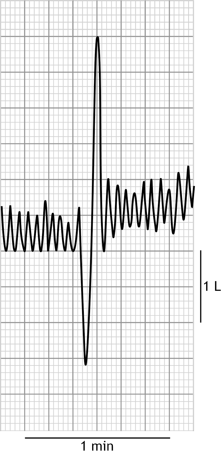<p>25. As part of an occupational health examination, a lung function test is performed. The figure below shows a result of the spirometric examination. Using the helium wash-in method, the functional residual capacity is also determined to be 2.9 L.</p><p>What is the most likely residual volume in this case?</p><p>A. 0.7 L</p><p>B. 1.3 L</p><p>C. 1.6 L</p><p>D. 2.2 L</p><p>E. 4.6 L</p>