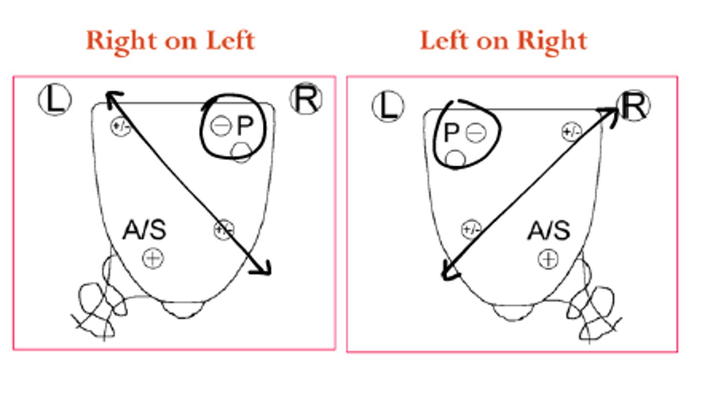 <p>For a backward sacral rotation, the rotation and axis direction are the ________________.</p>