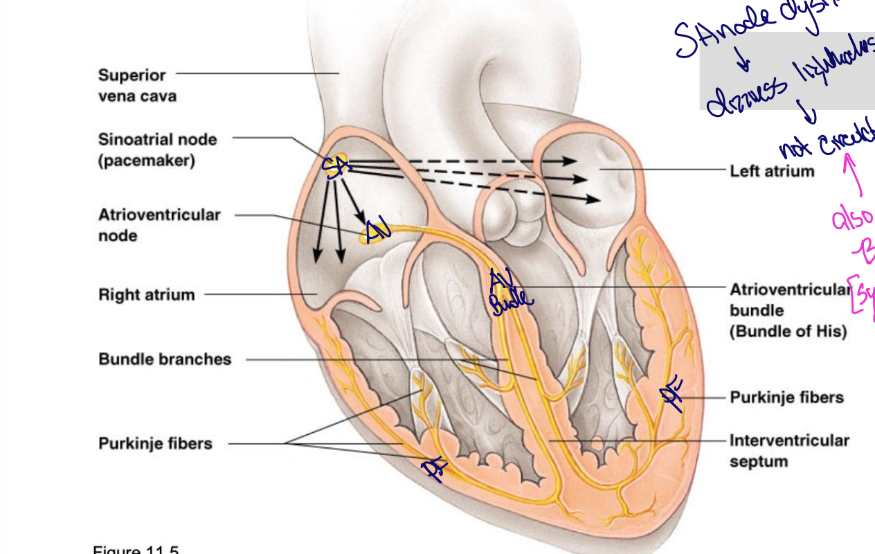 <p>Dizziness, fatigue, fainting, SOB, no longer circulates volume effectively - also a symptom of B-blockers (symptomatic Bradycardia)</p>