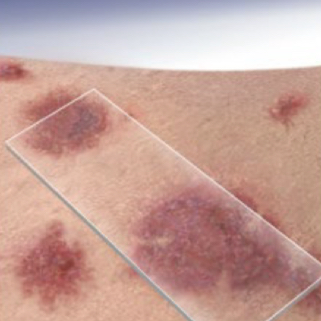 <p>what type of lesion is depicted</p>