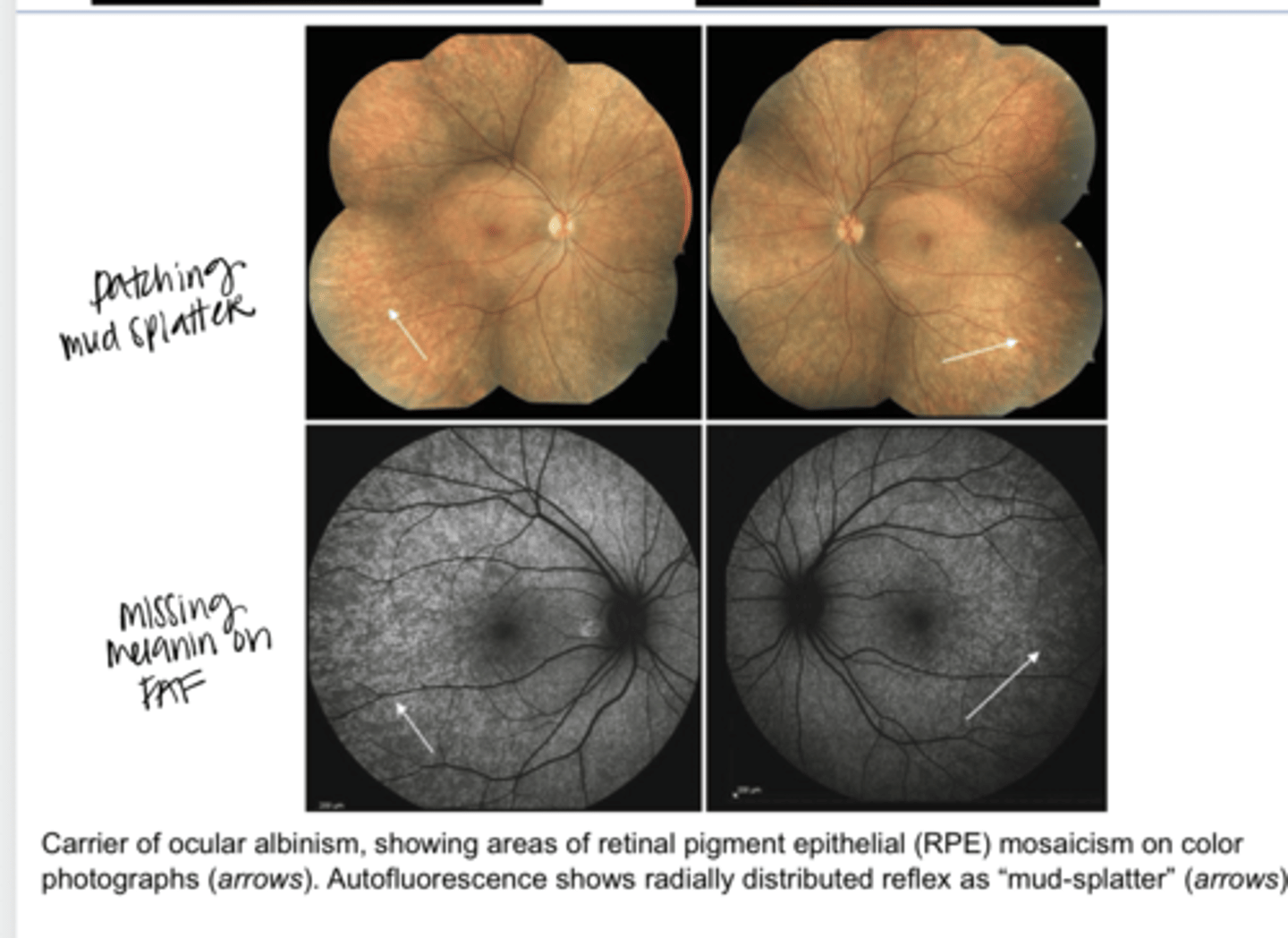 <p>Carrier of Ocular Albinism -- Showing Areas of RPE Mosaicism &amp; Mud Splatter Appearance (Pic)</p>