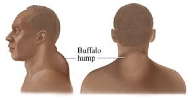 <ul><li><p>resulting from chronically <strong><u>HIGH levels of glucocorticoids&nbsp;</u></strong>(stress hormone)</p></li><li><p>it causes <strong>lipolysis &amp; a redistribution of fat </strong>that can produce a&nbsp;“buffalo hump” (a fatty deposit between the shoulders and below the back of the neck), a '“moon face” (round) and other symptoms</p></li></ul><p></p>
