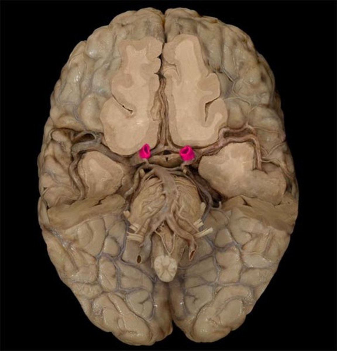 <p>posterior to optic chiasm</p>