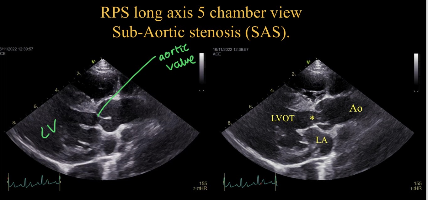 <p>LV concentric hypertrophy </p><p>Turbulence at narrowing </p><p>Aortic regurgiation </p>
