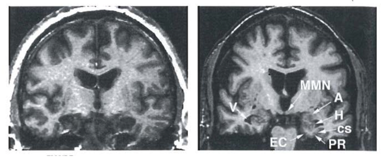 <ul><li><p>suffered from epileptic seizures</p></li><li><p>Had a lobectomy and removed 8cm of the <strong>bilateral medial temporal lobe</strong> (cortex, amygdala, and anterior 2/3 of hippocampus)</p></li><li><p><strong><u>Effects</u></strong>: </p></li></ul><p>1.<strong> Severe anterograde amnesia (declarative memory)=</strong> can’t convert new SM into LM</p><ol start="2"><li><p><strong>Partial retrograde amnesia (nondeclarative)</strong>= for few years before the surgery. Remembers his childhood. hm retained procedural but lost episodic </p></li><li><p><strong>Normal perception, intelligence, and personality</strong></p></li><li><p><strong>Normal Working memory= </strong>will remember shortly but when distracted will completely forget</p></li></ol><p><strong>Brenda Miller studied him</strong></p>