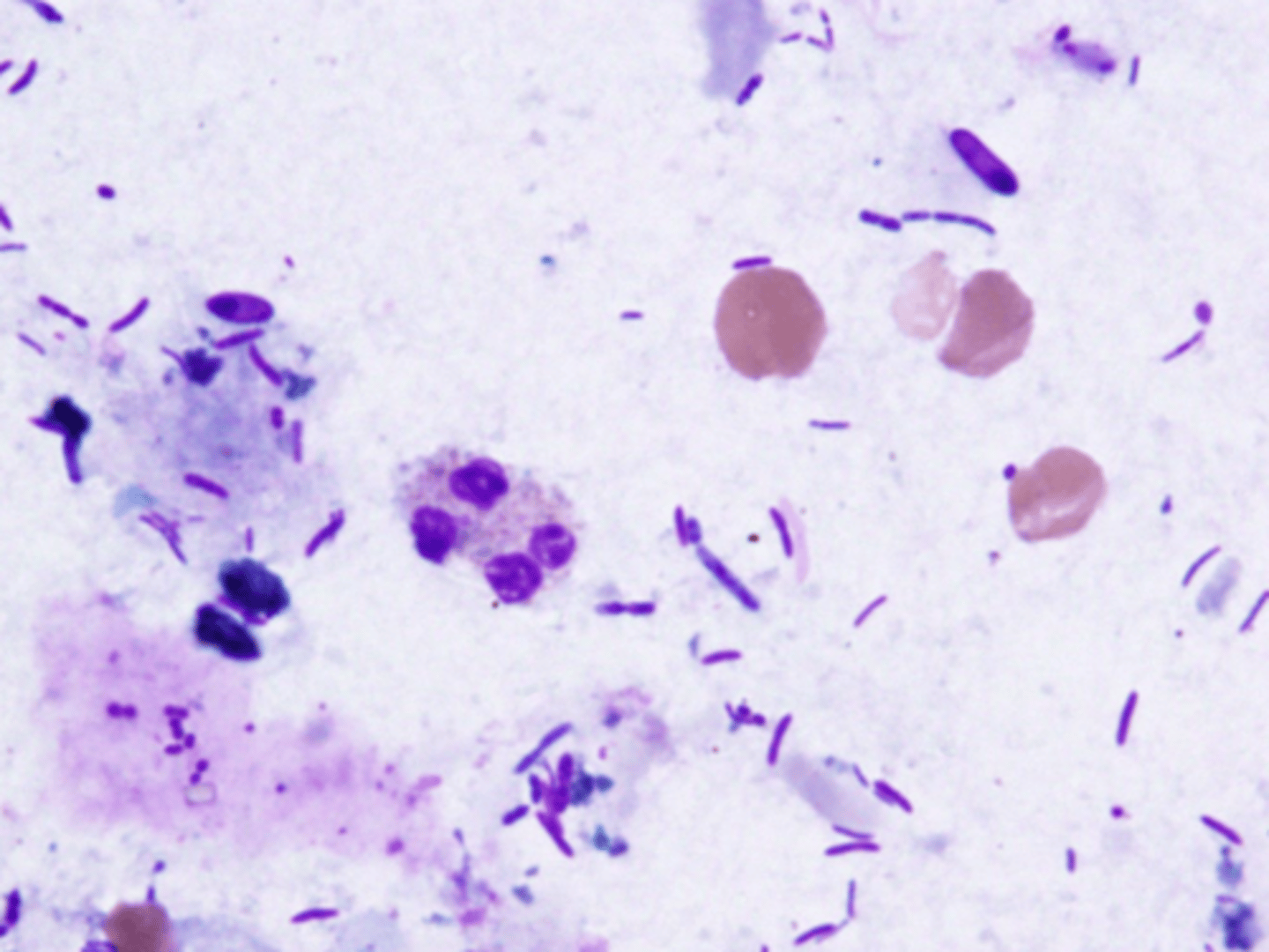 <p>What does a positive fecal smear for Leukocytes indicate?</p>