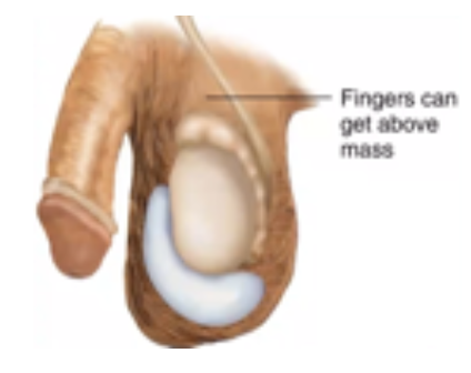 <p>Type of swelling‬ in the scrotum, the pouch of‬ skin that holds the testicles‬</p>