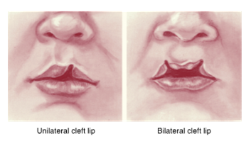 <ul><li><p>results from failure of fusion of the maxillary process with the medial nasal process </p></li><li><p>varying degrees of disfigurement </p></li></ul><p></p>