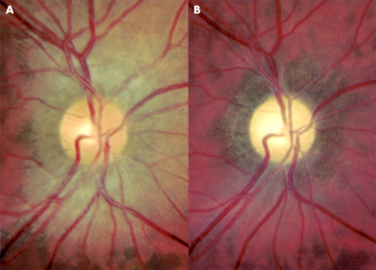 <p>intracranial injury to ON</p>