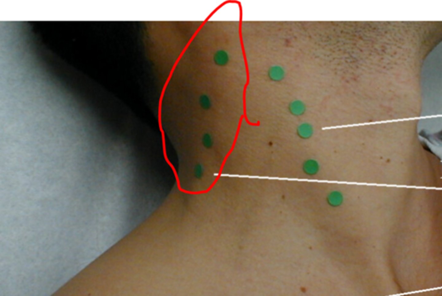 <p>Along the edge of the Trapezius Muscle</p>