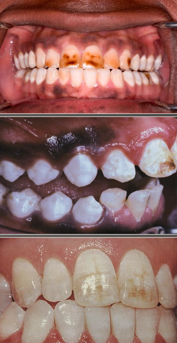 <p>Mottled enamel; hypomineralization- creating chalky white areas; severity is dose dependent; ingestion of excess amount of fluoride; retention of amelogenin protein in enamel</p>