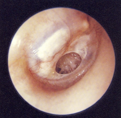 <p><u>disordered otoscopy: eardrum/TM</u></p><p>TM perforation</p>
