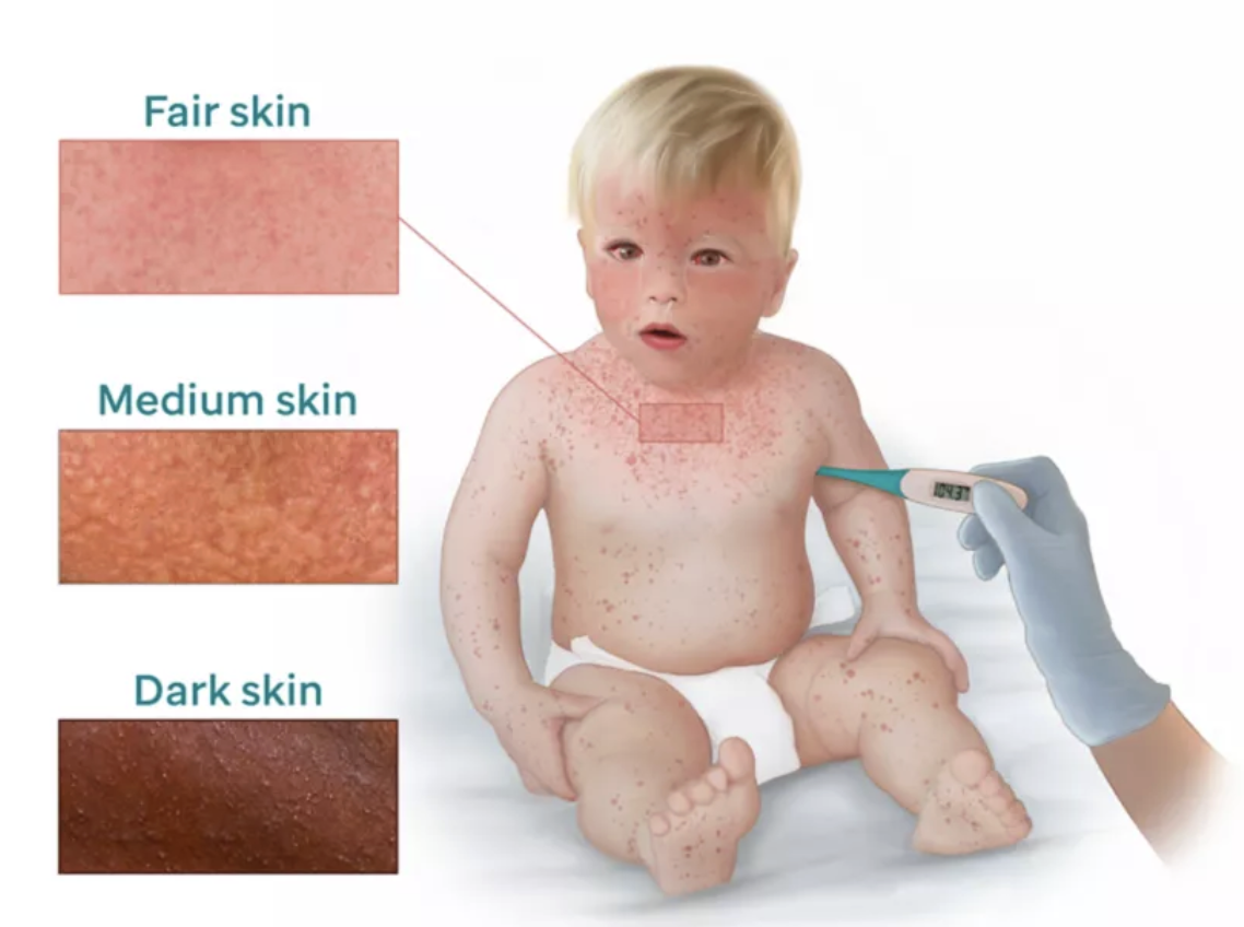 <ul><li><p>PROMINENT RASH</p></li></ul><ul><li><p>Early → 4-7 days after exposure</p><ul><li><p>Runny nose, cough, red and watery eyes, small white spots inside the cheeks</p></li></ul></li></ul><p></p>