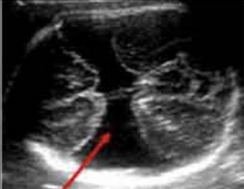 <p>a) holoprosencephaly</p><p>b) lisssencephaly</p><p>c) iniencephaly</p><p>d) schizencephaly</p>
