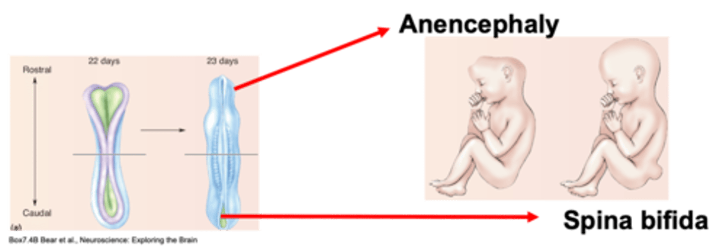 <p>A defect closing at the top, rostrally, where the brain develops is known as ...?</p>
