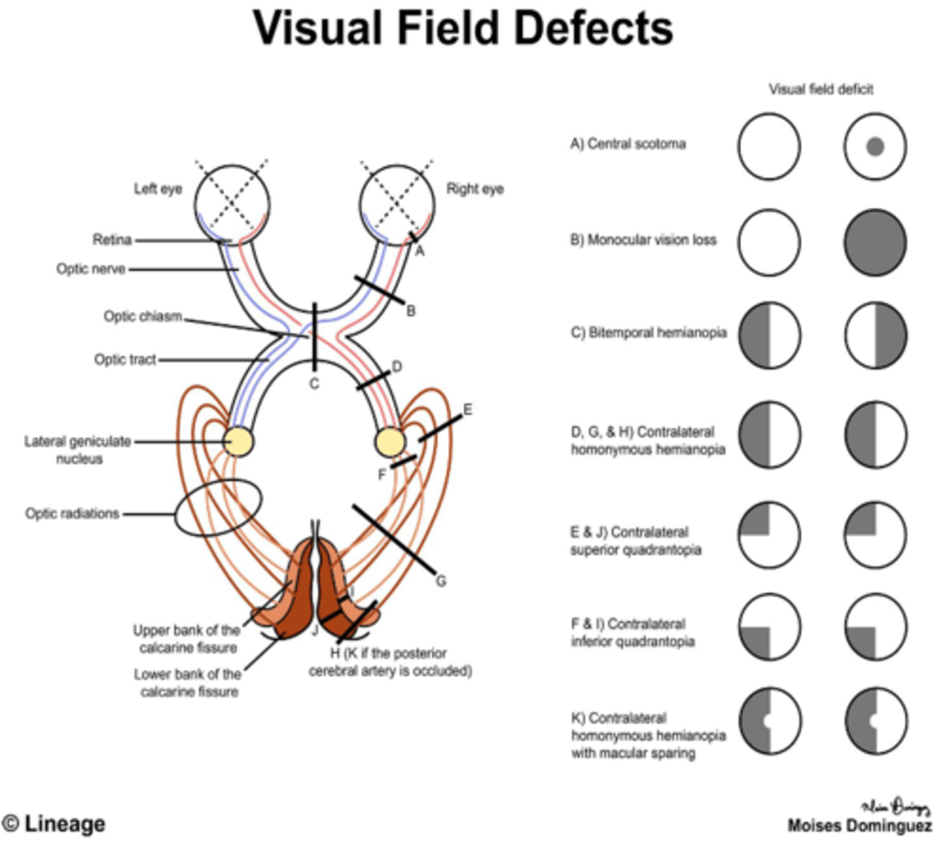 <p>Bitemporal hemianopsia</p>
