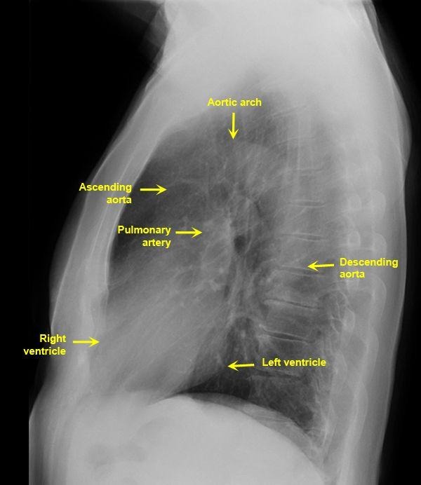 <p>Lateral CXR</p>