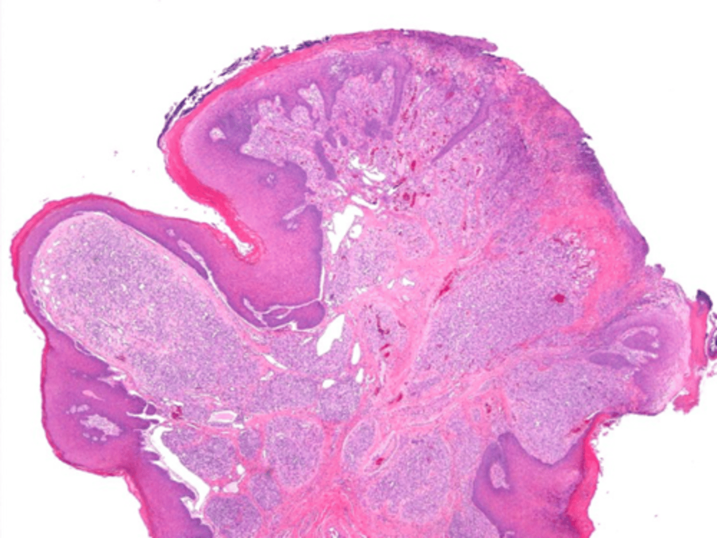 <p>Vascular proliferation of granulation tissue is associated with what pathology?</p>