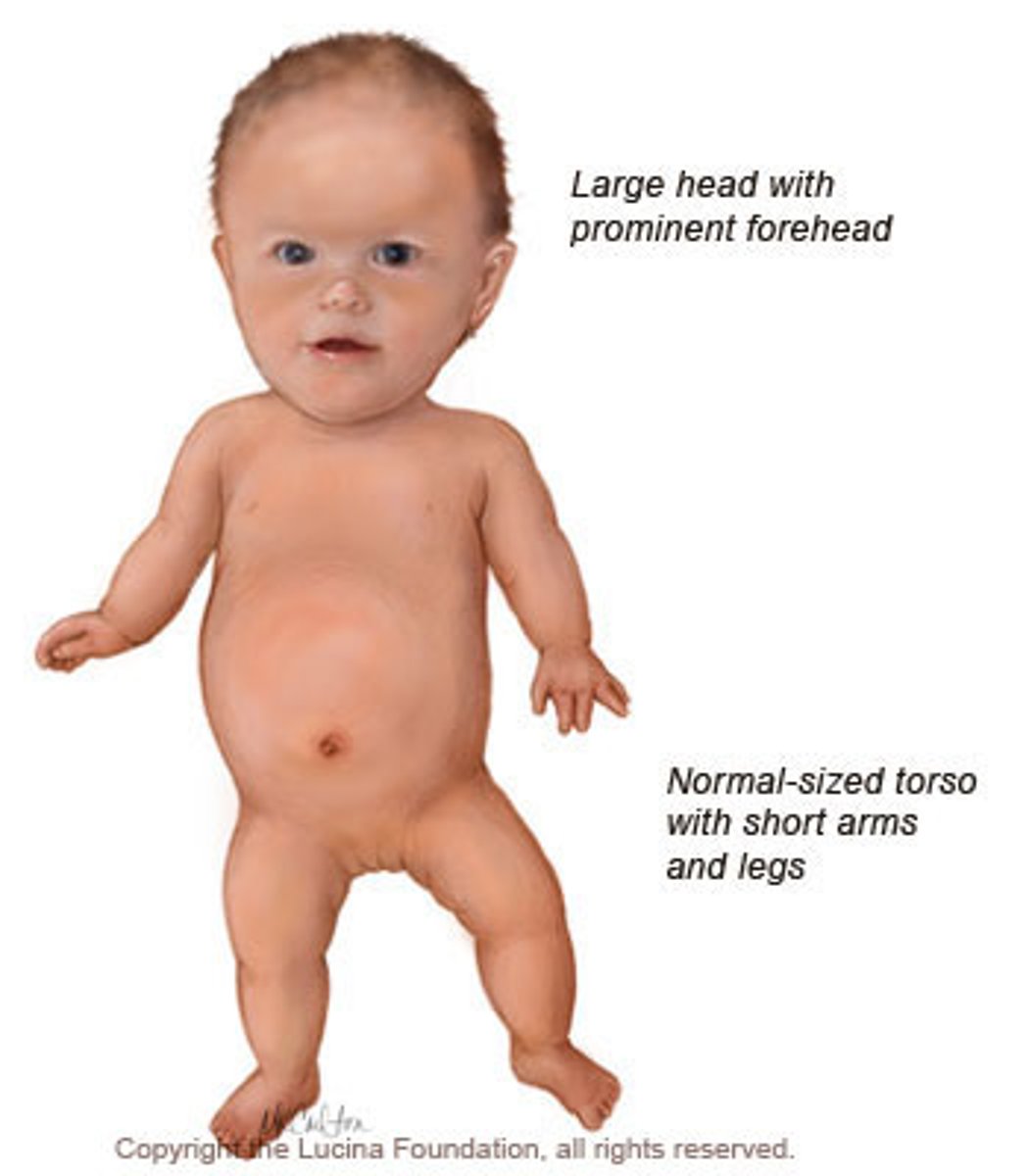 <p>Most common cause of dwarfism!</p><p>What is the pathophys?</p><p>Due to a failure of longitudinal bone growth (endochondrial ossification) that results in SHORT LIMBS! Note that membranous ossification is not affected thus, the head is relatively large compared to the limbs.</p><p>What is the mutation?</p><p>- due to constitutive activation of fibroblast growth factor (FGFR3) which actually INHIBITS chrondrocyte proliferation</p><p>- greater than 85% of mutations occur sporadically</p><p>- autosomal dominant with full penetrance (homozygous is lethal)</p>