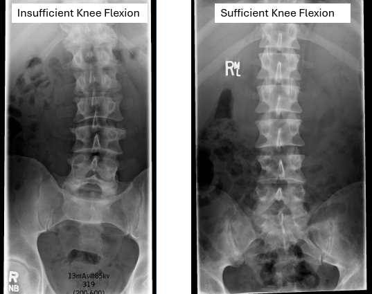 <p>no waist F/E, sufficient knee flexion </p><ul><li><p>IV disk spaces open, except L5-S1</p></li><li><p>VB with no distortion</p></li><li><p>minimal foreshortening of sacrum </p></li></ul><p></p>