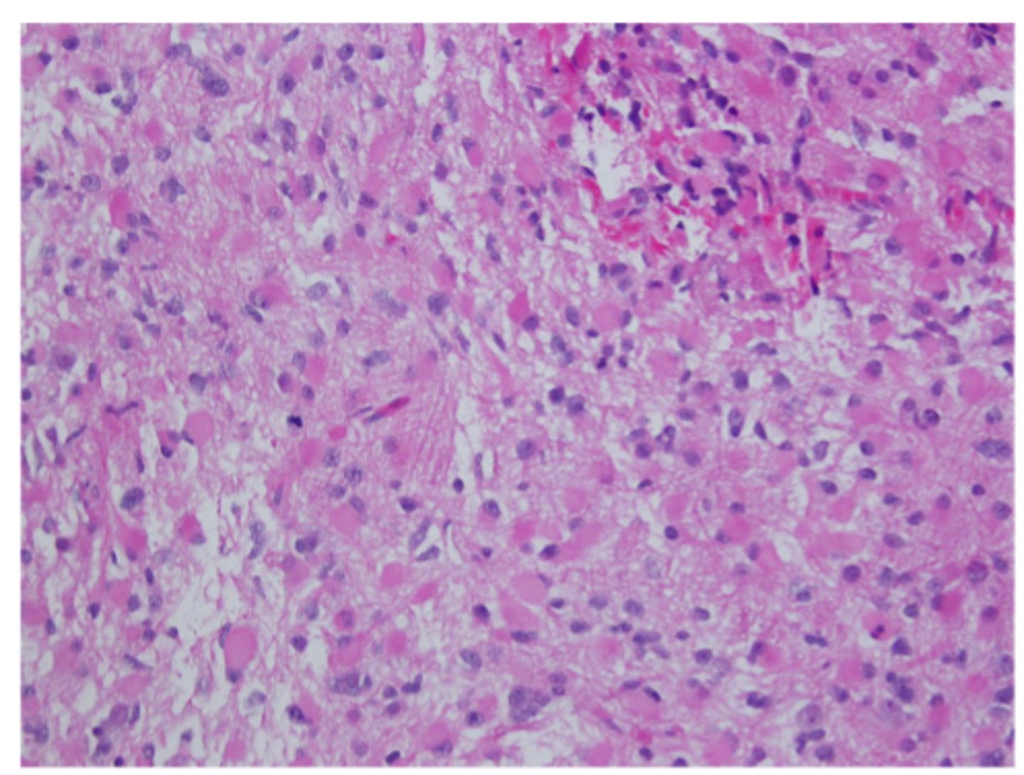 <p>a type of brain tumor that originates from astrocytes, with pleomorphism present</p>