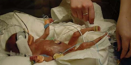 <p>Een ernstige darmontsteking die gepaard gaat met ischemie van de darm waardoor delen van de darm kunnen afsterven (necrose).</p><p>Het komt voor bij 1-5% van de prematuren en heeft een mortaliteit van 40%. De oorzaak is niet gekend maar risicofactor zou zijn dat de darm onrijp is en dat de darm daardoor gevoeliger is voor bacteriën.</p><p>Er wordt een correlatie gezien tussen het starten van de voeding (ook sondevoeding) en necrotiserende enterocolitis. De incidentie verhoogt ook bij een laag geboortegewicht.</p><p>Symptomen:</p><p>-Residu in de maag mag <u>maximum 10%</u> van de vorige voeding zijn, meer is een symptoom (je zuigt bij de controle wat op en als je melk ziet trek je op tot je niks meer kan optrekken → je kan wat is opgetrokken wel of niet terugspuiten afhankelijk van de arts).</p><p>-Gallig braken.</p><p>-Opgezet abdomen, pijn bij palpatie.</p><p>-Bloederige ontlasting.</p><p>-Symptomen van infectie (bleek, grauw, apneu + bradycardie).</p>