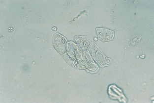 Squamous epithelial cells clumped together