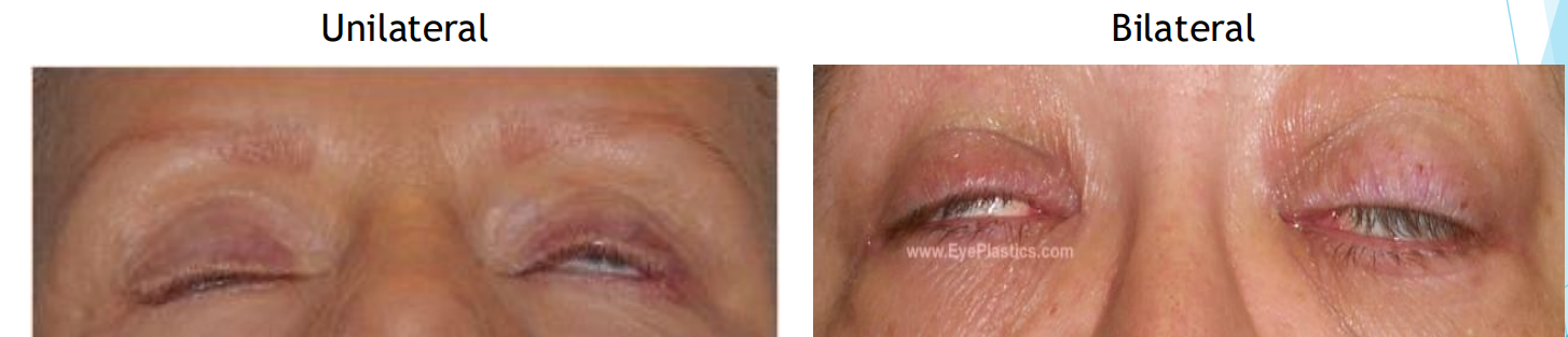 <p>Incomplete eyelid closer</p>