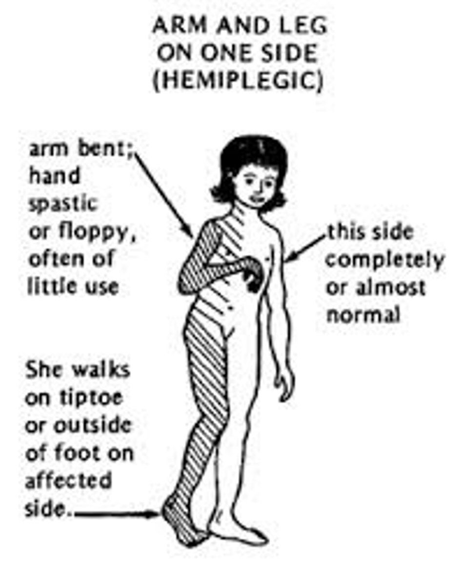 <p>completely paralysis of one half of the body<br>- due to contralateral damage/lesion</p>