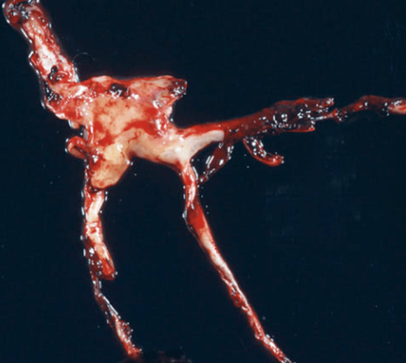 <p>This is an image of a postmortem clot. What are the two types of postmortem clots?</p>