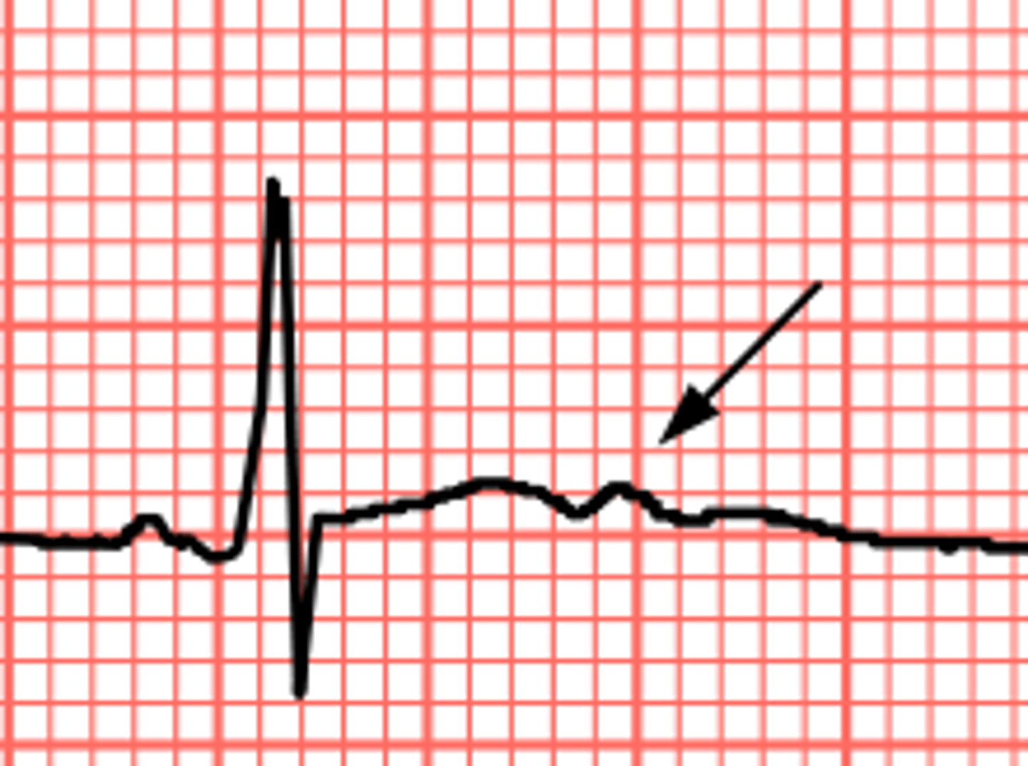 <p>___wave is seldom seen.</p><p>it represents the repolarization of the Purjinkie fibers</p><p>indicates hypokalemia</p><p>it is part of ventricular repolarization</p>