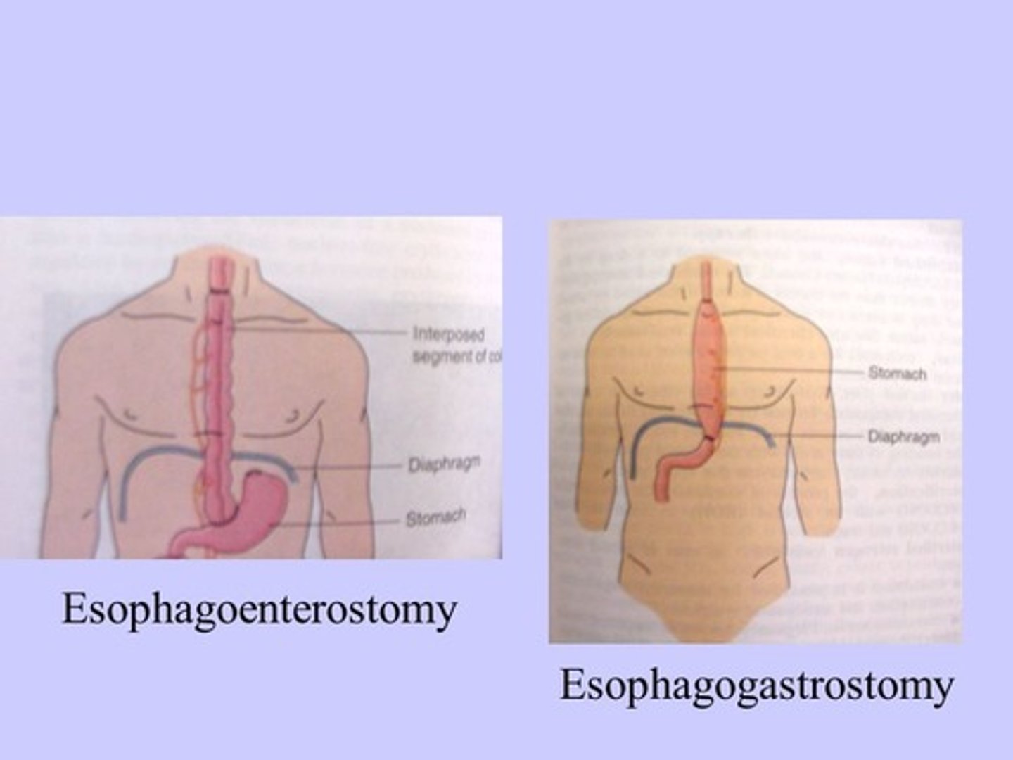 <p>resection of a portion esophagus and anastamosis of a segment of the colon to the remaining portion</p>