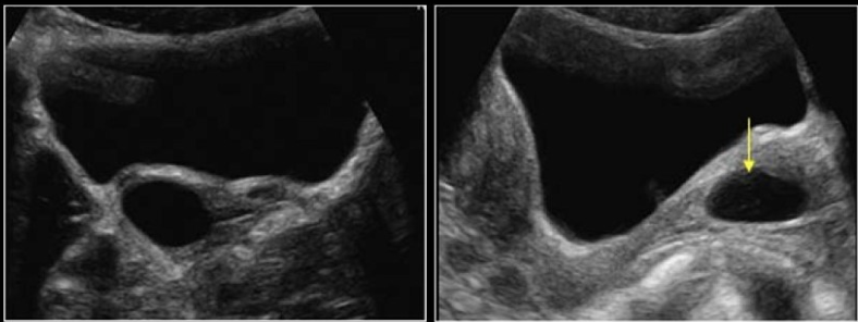 <p>a pt has palpable, pliable, rounded, mobile mass in <strong>vaginal canal</strong></p><p>a) gartner cyst</p><p>b) fibroid</p><p>c) brenner cyst</p><p>d) nabothian cyst</p>