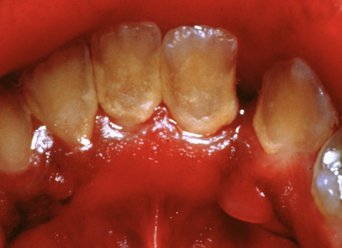 <p>a normal anatomic variant that appear as bumps on the back on the mandibular canines</p><p>they will also be bilateral </p>