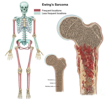 <p><strong>Ewing Sarcoma: Background</strong></p><p>-Malignant tumor of _____ and _____ tissue</p><p>-Second most common but most _______ malignant bone tumor in childhood </p><p>-Epidemiology </p><ul><li><p>Peaks between ___-___ years old</p></li><li><p>Male > female</p></li><li><p>Most common in Caucasians </p></li></ul><p>-Pathogenesis </p><ul><li><p>Neural crest cell origin </p></li><li><p>Arises from _____ ________ and can break through cortex to form soft tissue mass </p></li><li><p>Most often occurs in the _________ of long bones or ____ bones (femur, _____, tibia most common)</p></li></ul><p>-Mets occur _______</p><p></p>