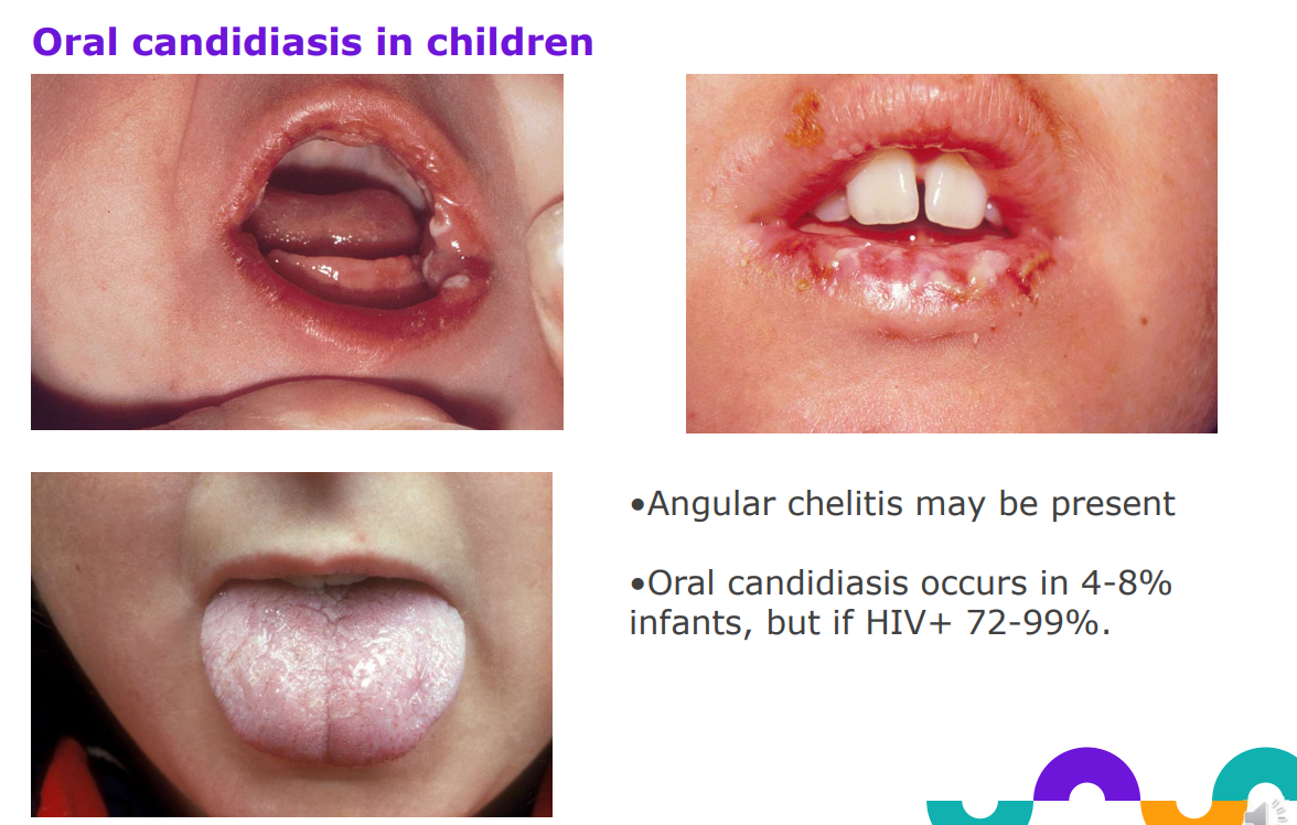 <ul><li><p>Angular chelitis - corner infection may be present</p></li><li><p>Oral candidiasis occurs in 4-8% infants, but if HIV+ 72-99%.</p></li></ul><p></p>