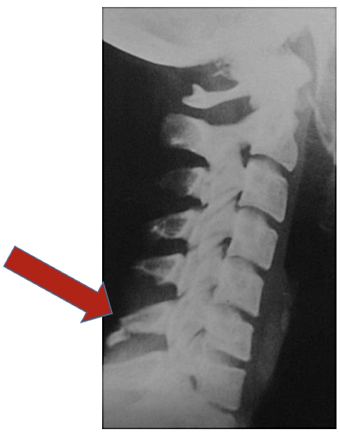 <p>Name this fracture</p>