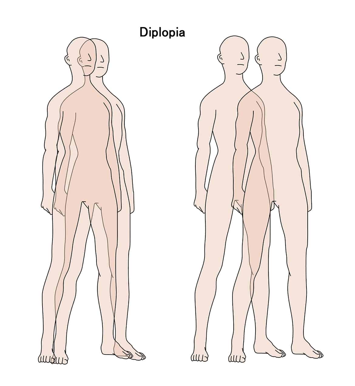 visual impairment in which an object is seen as two objects. Double vision. 