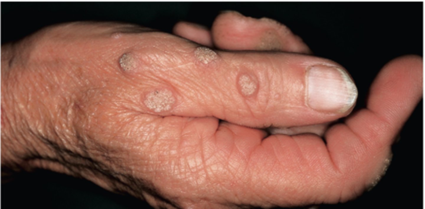 <p>warts (verrucae)</p><p>genital warts (condyloma acuminatum)</p>