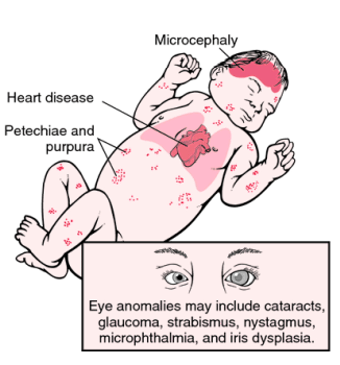 <p>infection of rubivirus that occurs due to maternal viremia. It is spread trans placentally to the fetus. After birth infants excrete the virus in the throat and urine. Infections that occur earlier in pregnancy are more severe.</p>