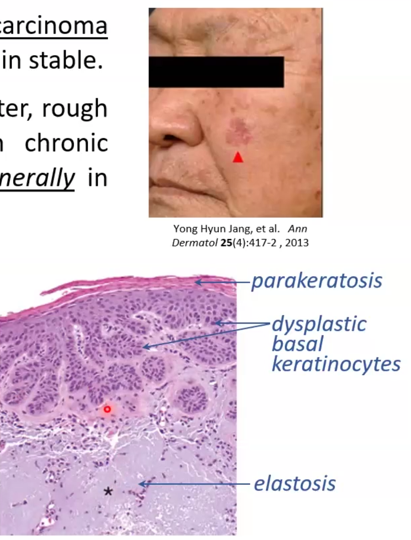 <ul><li><p>Pre-cancerous lesions tht may progress to squamous cell carcinoma</p><ul><li><p>circumscribed tan-brown or red lesions &lt;1cm in diameter that are <strong>sand-paper like</strong></p></li></ul></li><li><p>Pathogenesis: caused by UV-induced DN damage associated with <strong>TP53 mutations</strong></p></li><li><p>Micro Morphology: basal keratinocytes show dysplasia</p><ul><li><p>Parakeratotic scales and elastosis</p><p></p></li></ul></li></ul><p></p>