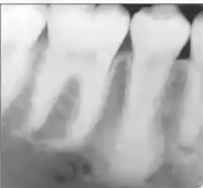 <p>What are some clinical and radiographic features of idiopathic osteosclerosis?</p>