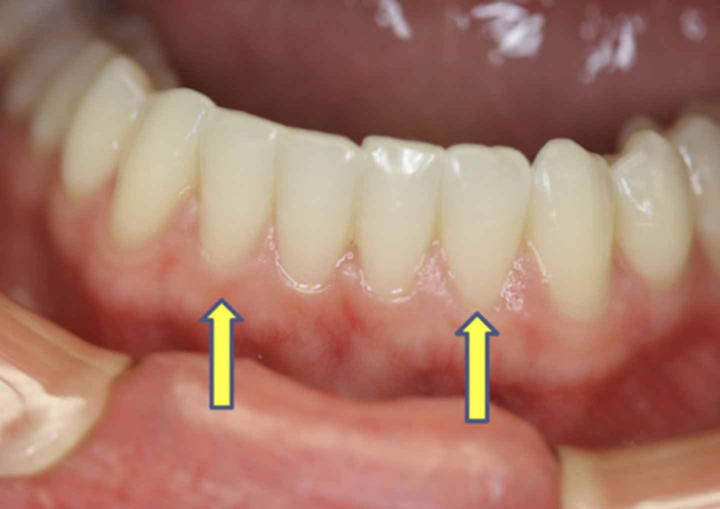 <p>- #23 and #26</p><p>- Eruption time= 7 to 8 years</p><p>- Root completion= 10 years</p><p>- Occludes with max central and lateral</p>