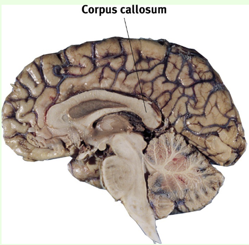<p>Corpus callosum </p>