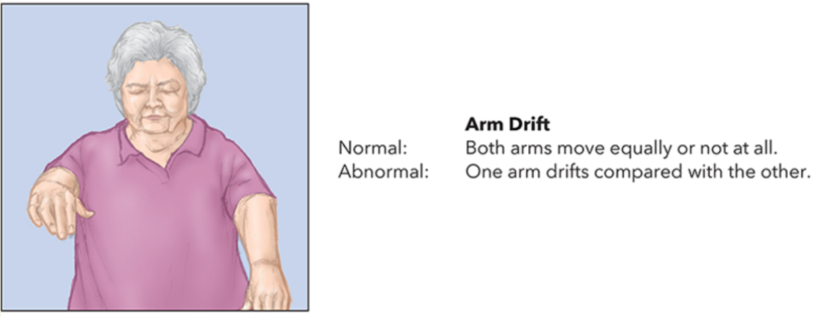 <ul><li><p>Ask the patient to close their eyes and extend their arms straight forward with the palms facing upward. Have this patient hold this position for 10 seconds.</p><ul><li><p>A normal response is for the patient to move both arms at the same time.</p></li><li><p>An abnormal response is for one arm to drift down or not move at all, or for the arms to turn downward so that the palms face the opposite direction.</p></li></ul></li></ul><p></p>