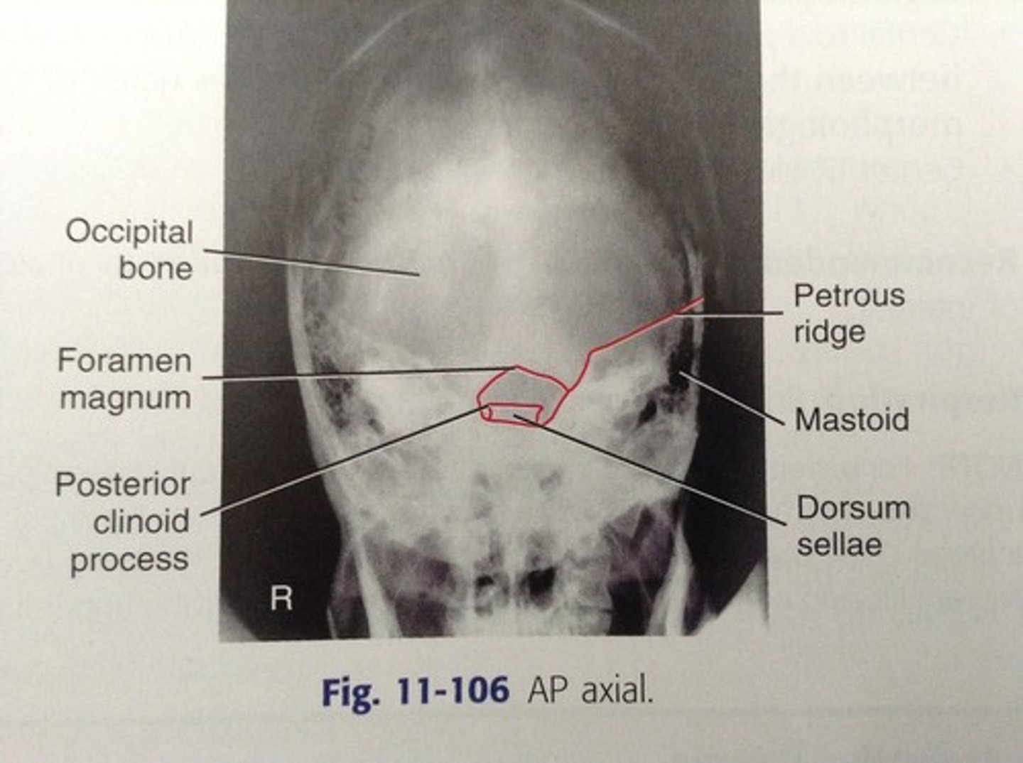 <p>Dorsum sellae &amp; posterior clinoids should be projected into the foramen magnum</p>